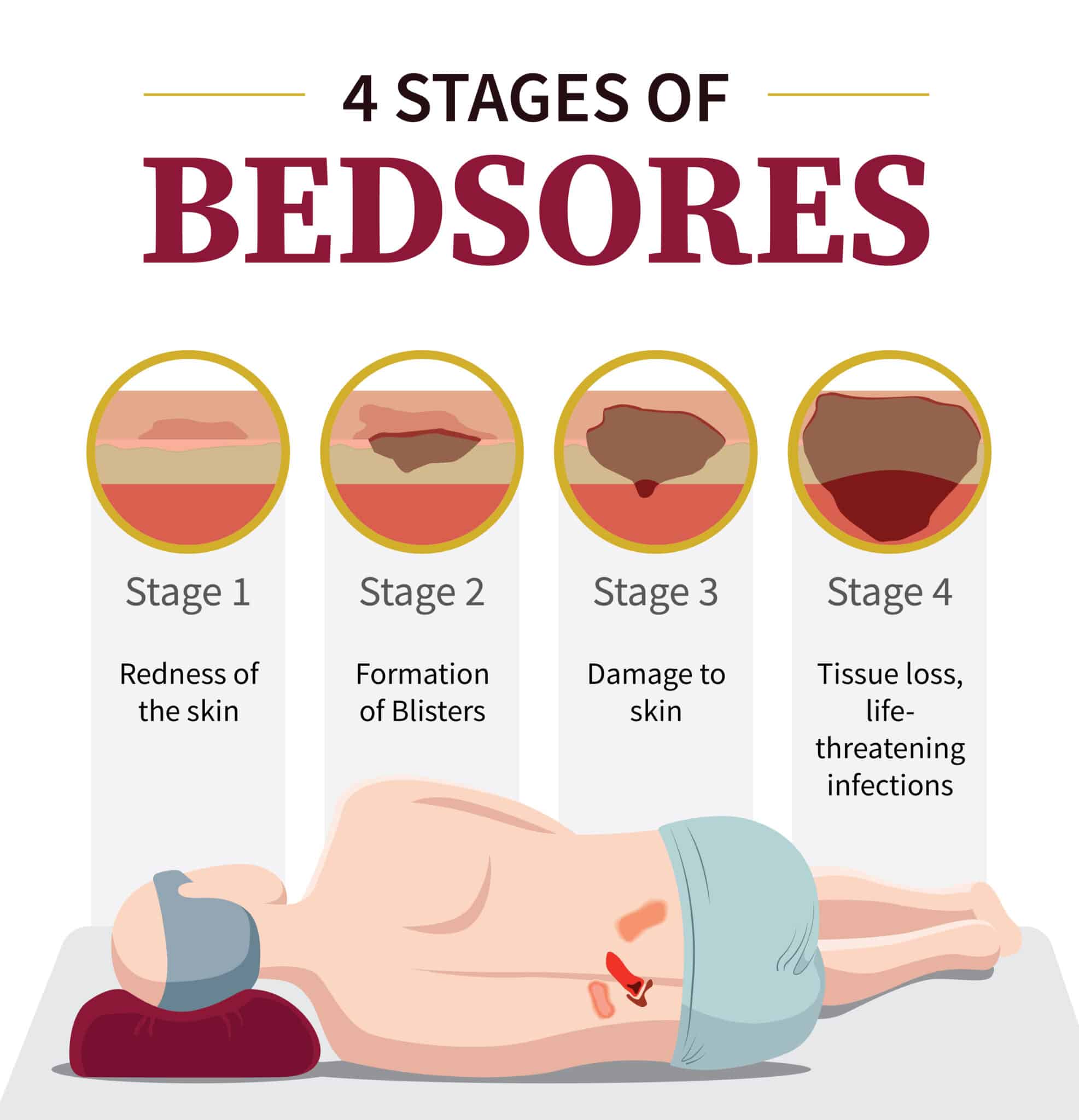 What are the 4 Stages of Bedsores? Nursing Homes Abuse