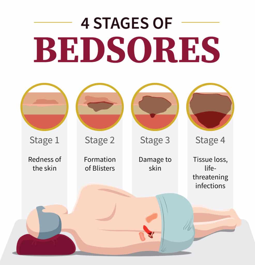 4 Stages of Bedsores Infographic