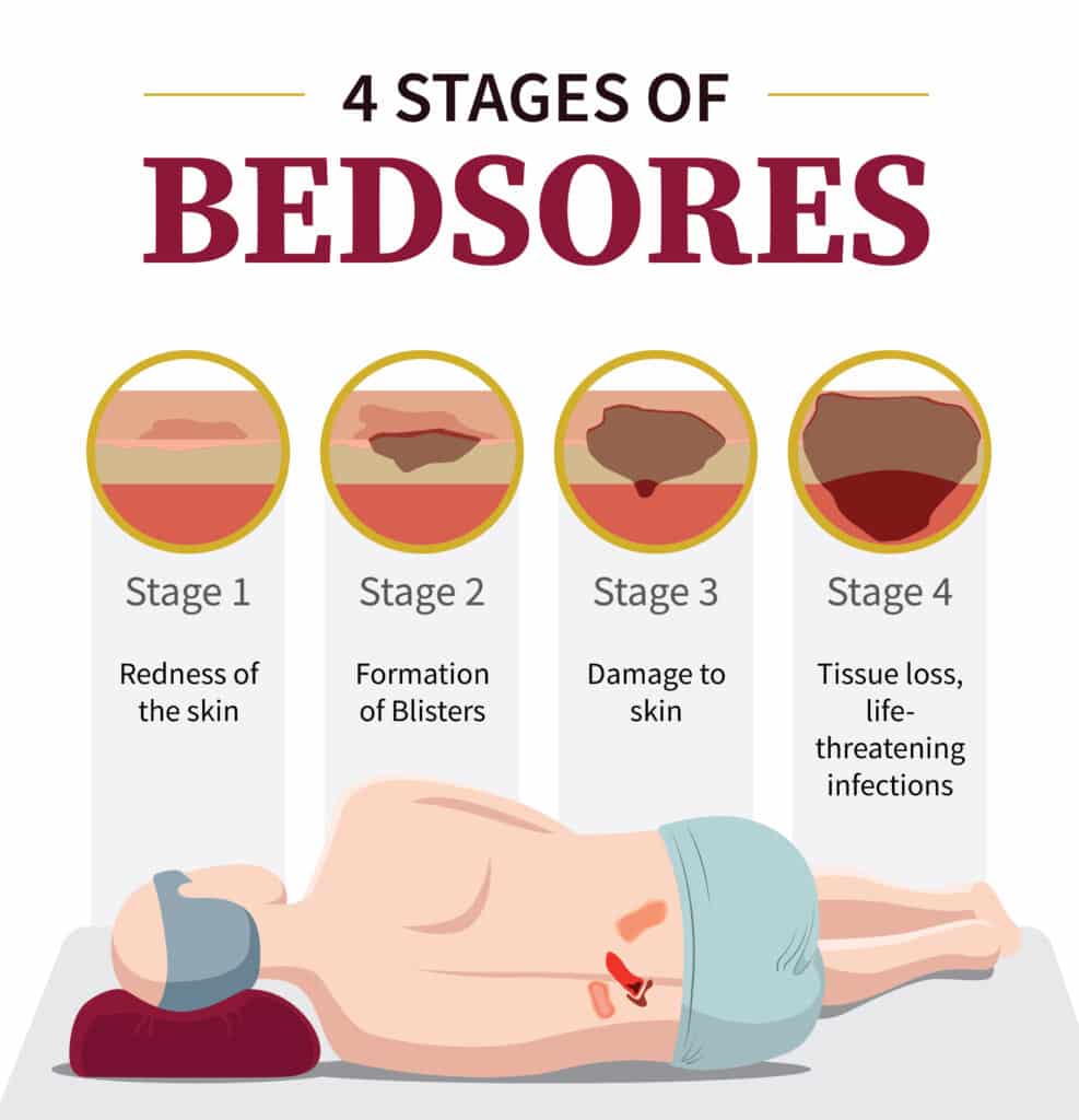 What are the 4 Stages of Bedsores? | Nursing Homes Abuse